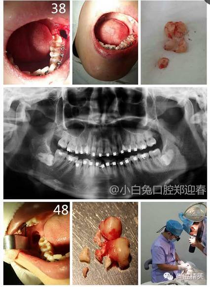 阻生齿微创舒适拔牙初级班
